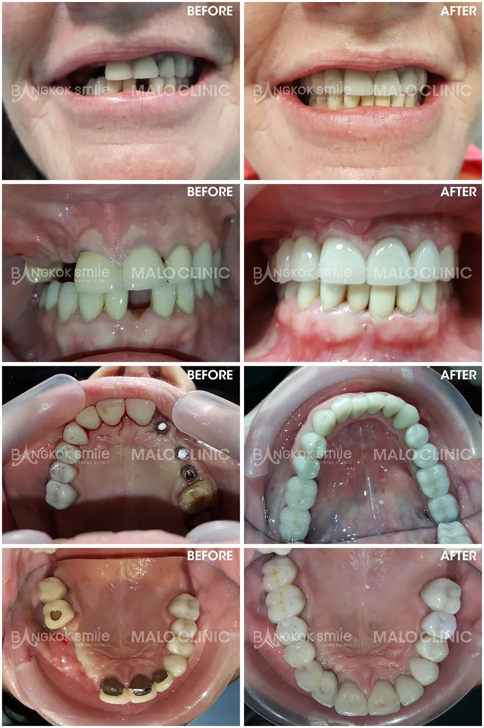 dental-crown-005