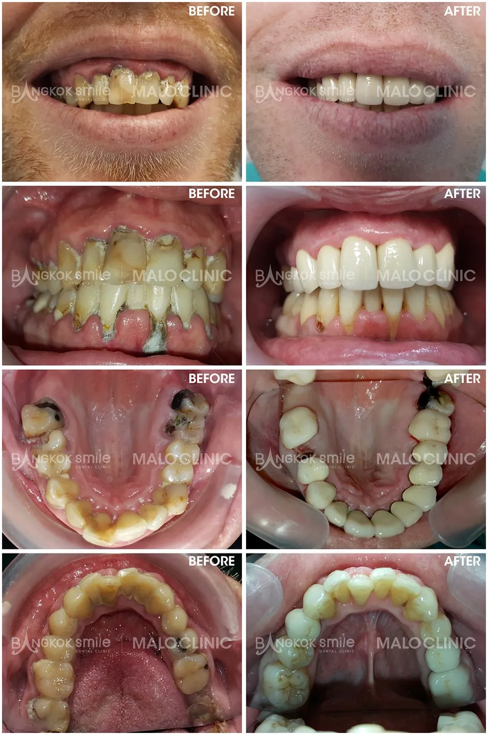 dental-crown-006