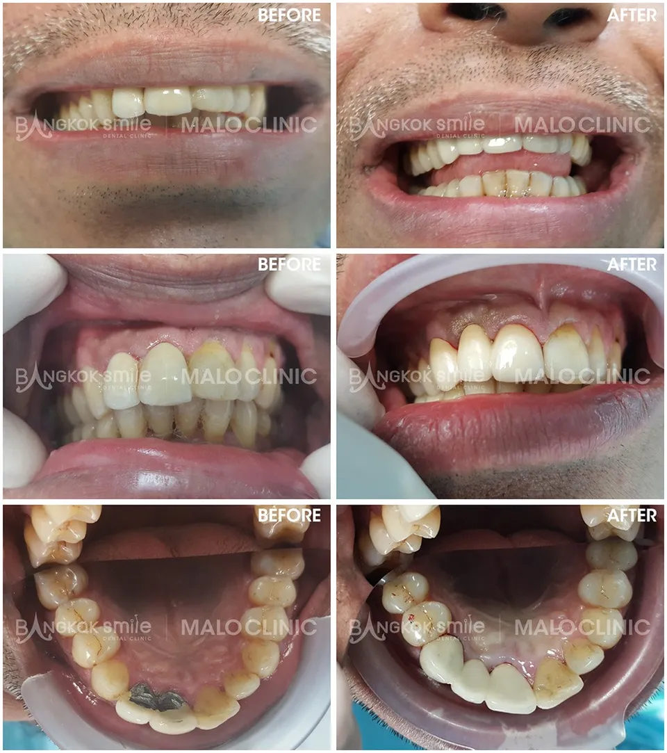 dental-crown-008
